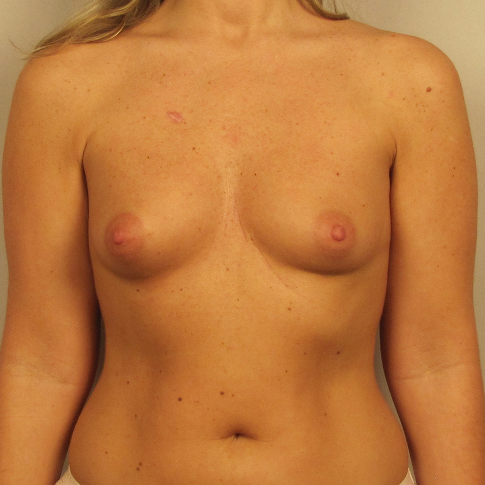 Case--3792 | Before Breast Augmentation