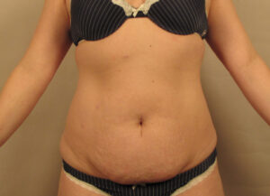 Case--5454 | Before Abdominoplasty 1