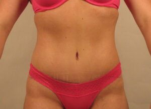 Case--5454 | After Abdominoplasty 1