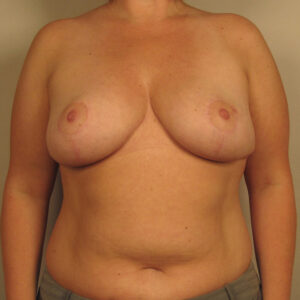 Case--4628 | After Bilateral Reduction Mammaplasty (Breast Reduction) 1