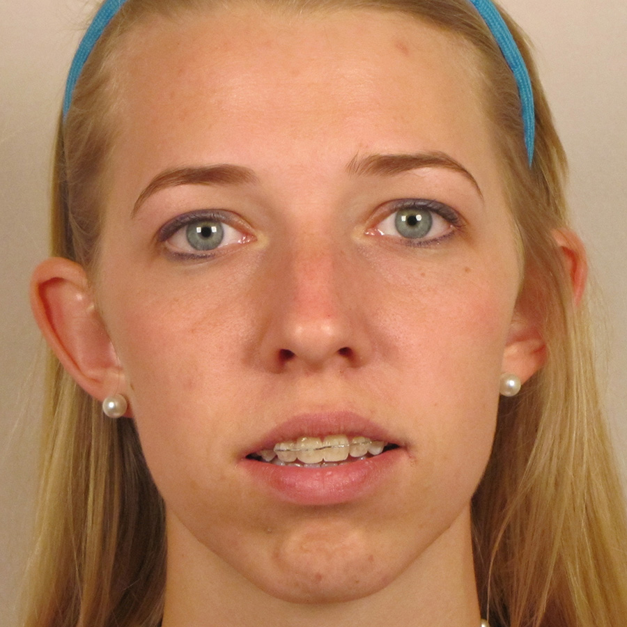 Case--2674 | Before Rhinoplasty