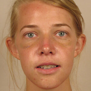 Case--2674 | After Rhinoplasty 1
