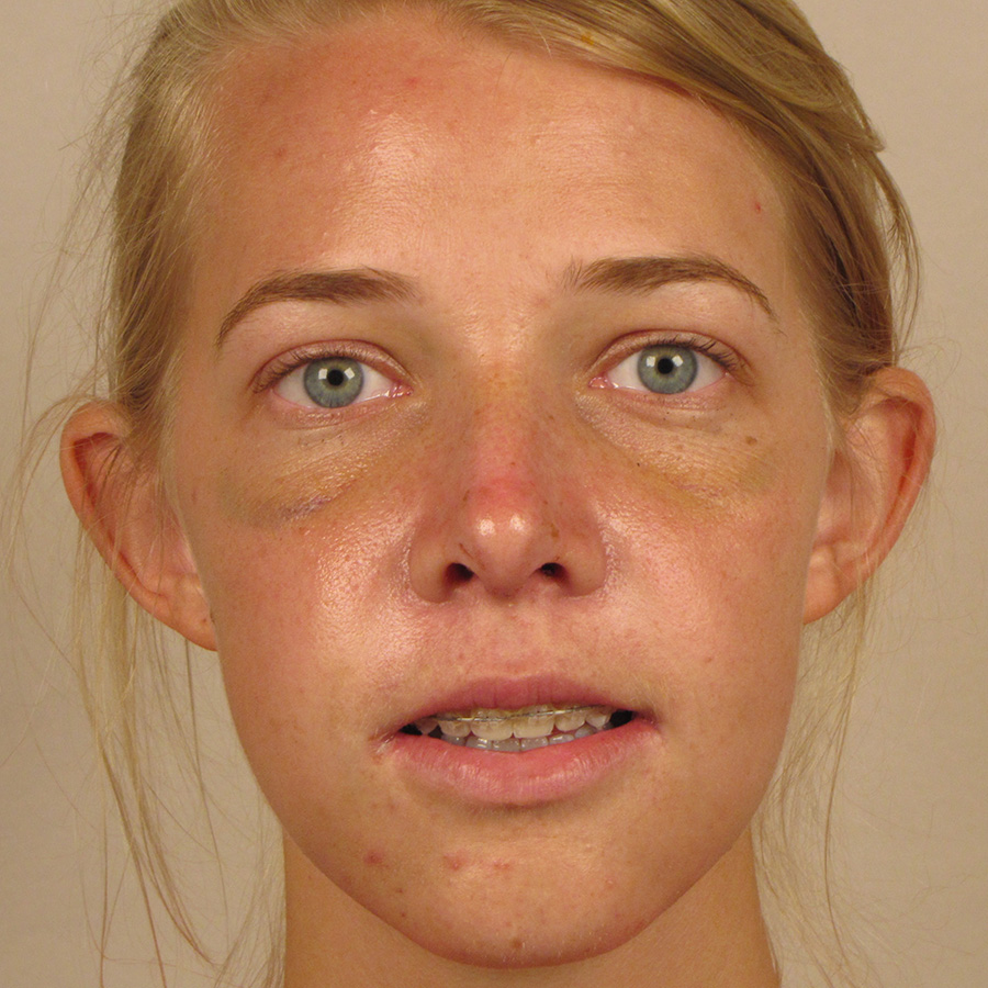 Case--2674 | After Rhinoplasty