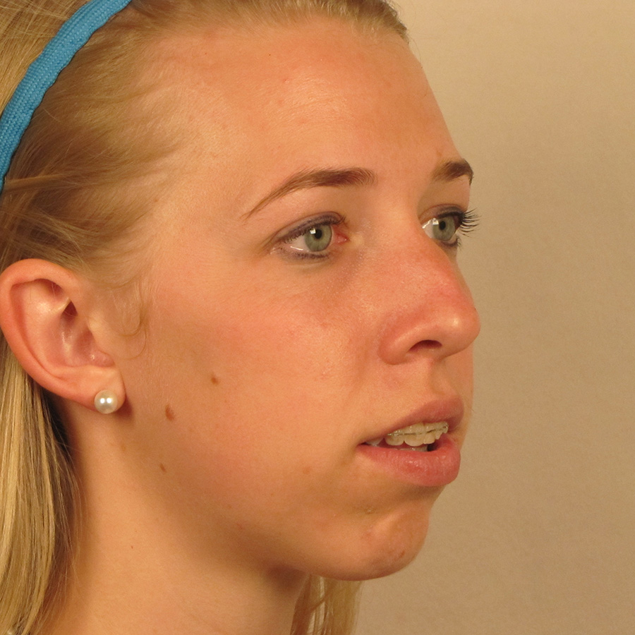 Case--2674 | Before Rhinoplasty 2