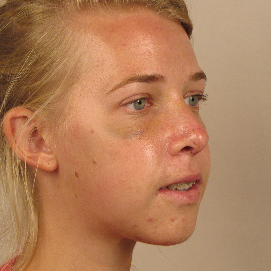 Case--2674 | After Rhinoplasty 2