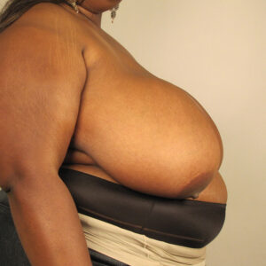 Case--3927 | Before Bilateral Reduction Mammaplasty (Breast Reduction) 2