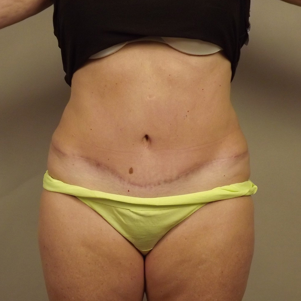 Case--7335 | After Body