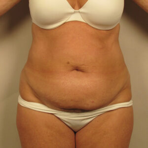Case--7335 | Before Abdominoplasty 1