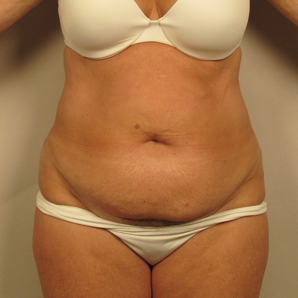 Case--7335 | Before Body