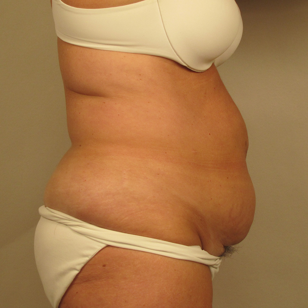 Case--7335 | Before Abdominoplasty 2
