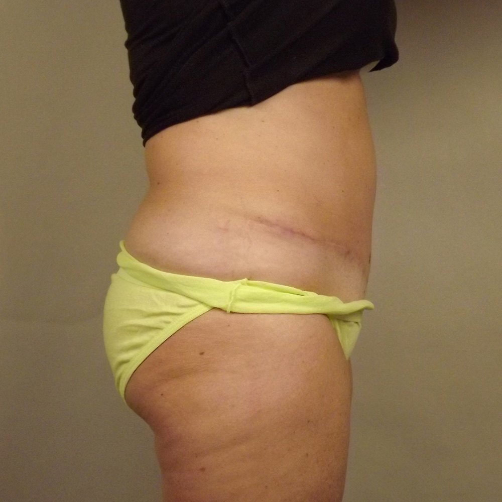 Case--7335 | After Abdominoplasty 2