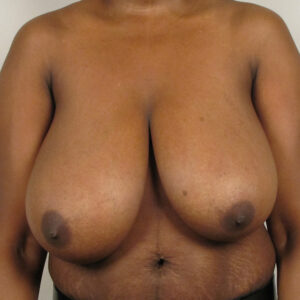 Case--9249 | Before Bilateral Reduction Mammaplasty (Breast Reduction) 1