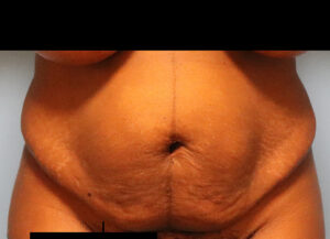 Case--3061 | Before Abdominoplasty 1