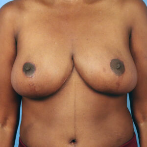 Case--9249 | After Bilateral Reduction Mammaplasty (Breast Reduction) 1