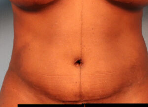 Case--3061 | After Abdominoplasty 1