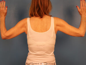 Case--42734 | After Arm Lift (Brachioplasty) 2
