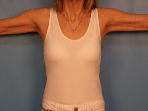 Case--42734 | After Arm Lift (Brachioplasty) 1