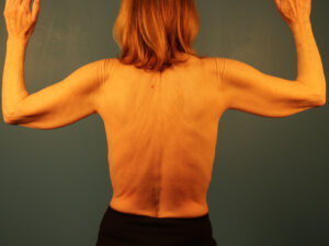 Case--42734 | Before Arm Lift (Brachioplasty) 2