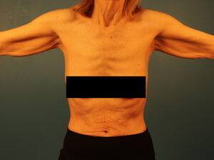 Case--42734 | Before Arm Lift (Brachioplasty) 1