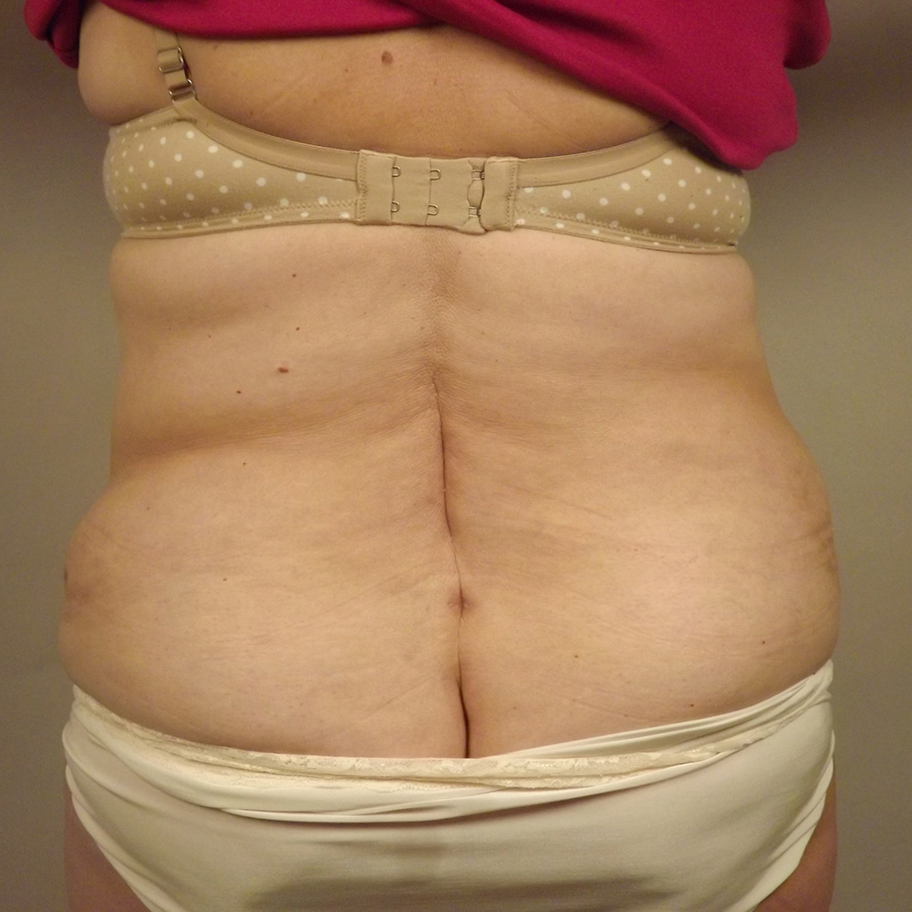 Case--1596 | After Liposuction