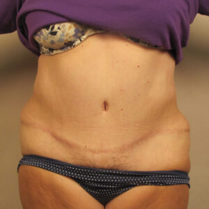 Case--6846 | After Abdominoplasty 1
