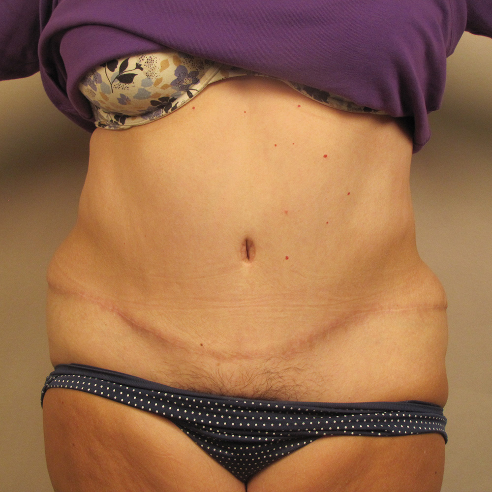 Case--6846 | After Body