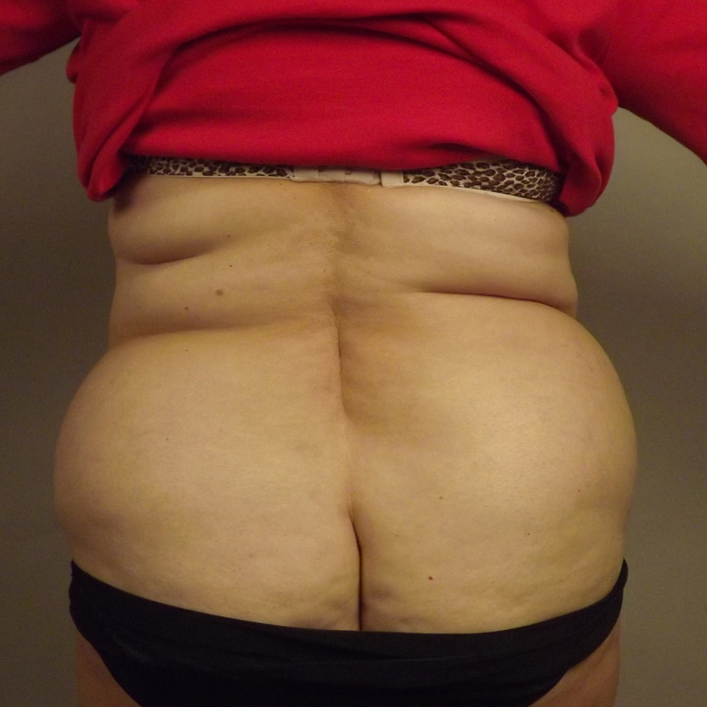 Case--1596 | Before Liposuction