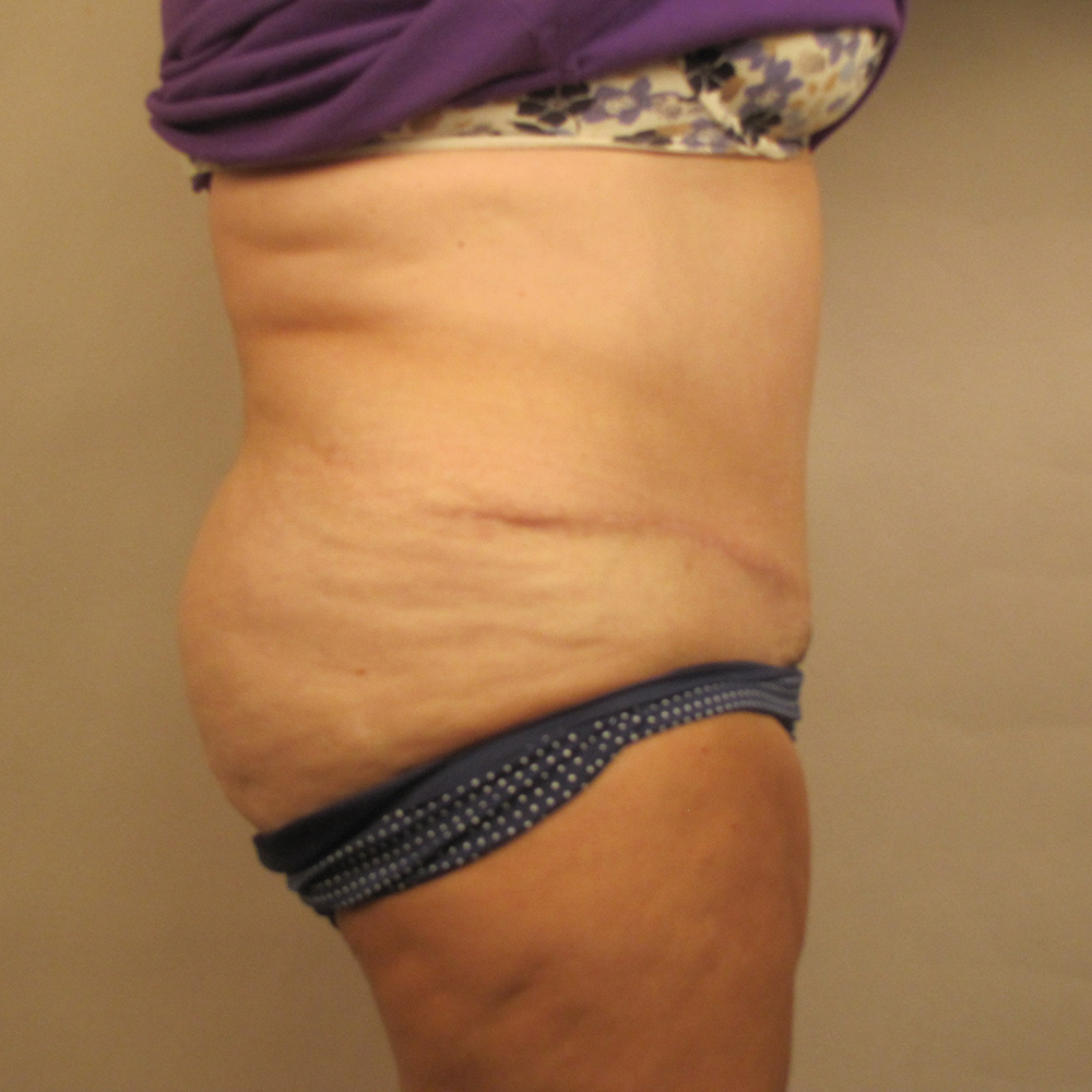 Case--6846 | After Abdominoplasty 2