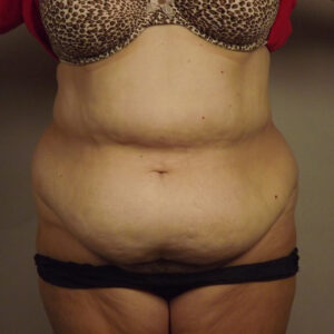 Case--6846 | Before Abdominoplasty 1