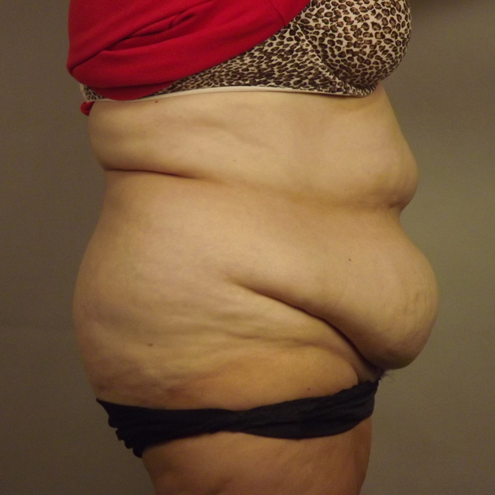 Case--6846 | Before Abdominoplasty 2