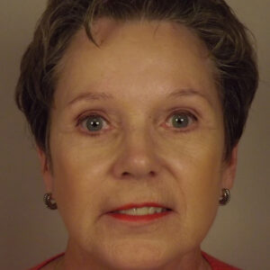 Case--9435 | Before Brow Lift 1