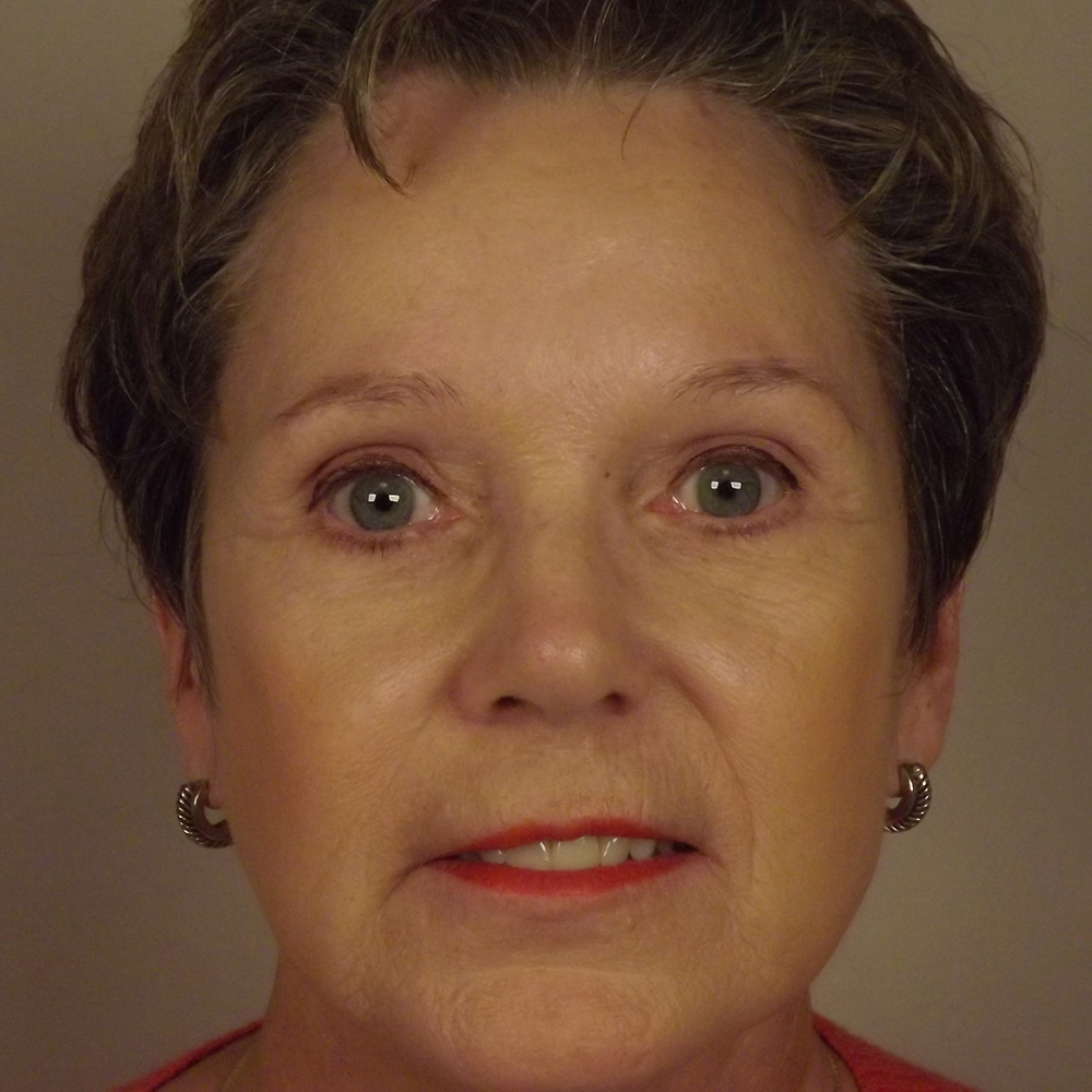 Case--9435 | Before Brow Lift