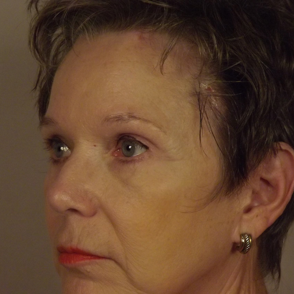 Case--9435 | Before Brow Lift 2