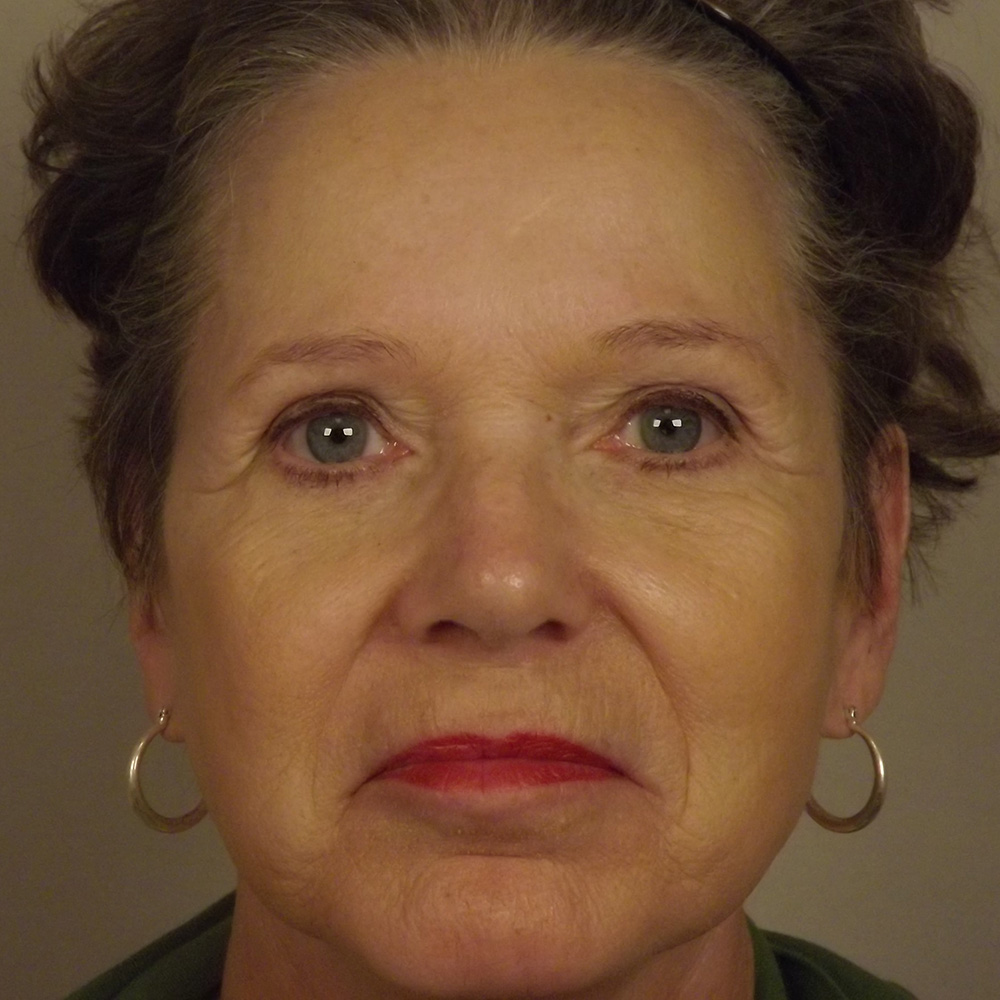 Case--9435 | After Brow Lift