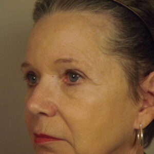 Case--9435 | After Brow Lift 2