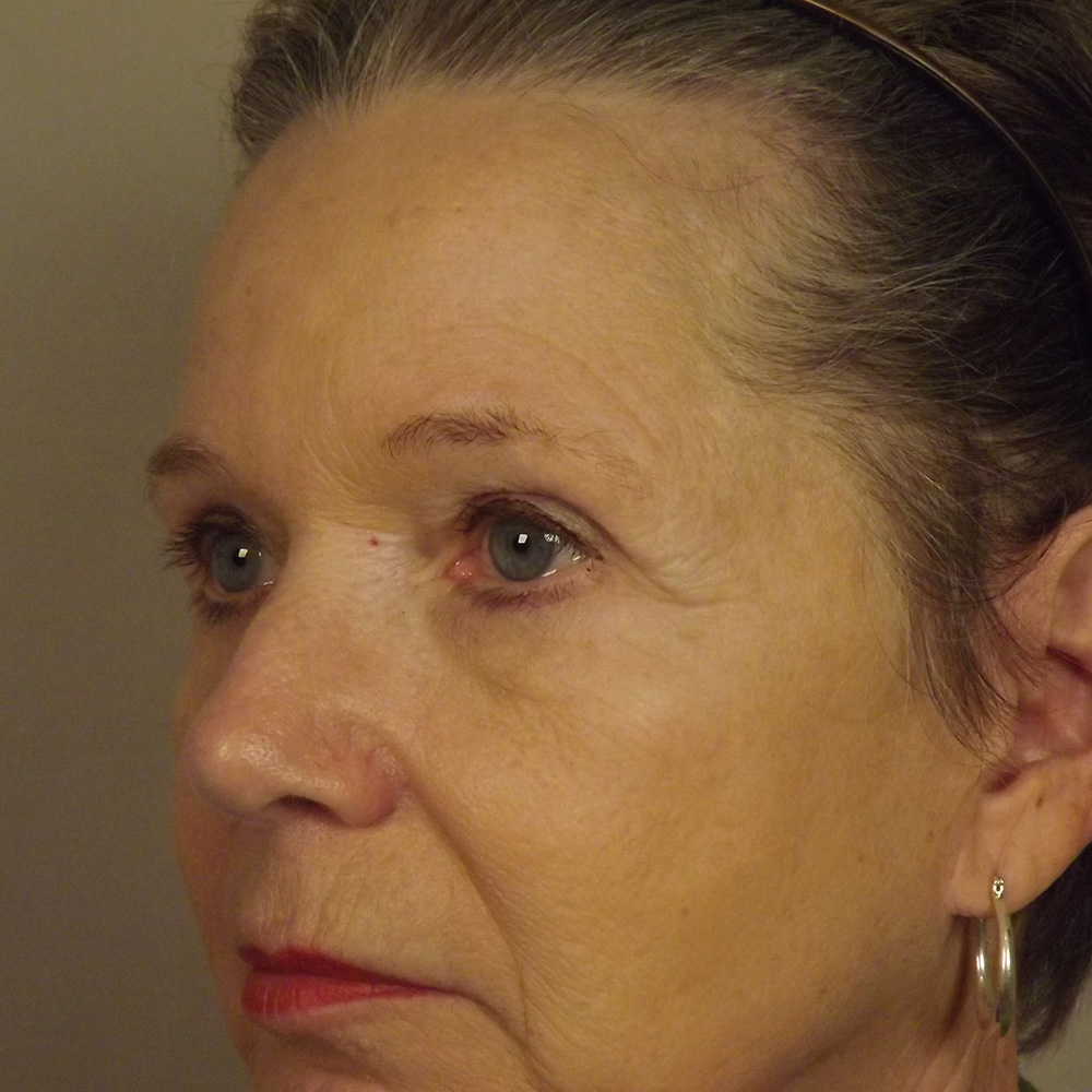 Case--9435 | After Brow Lift 2