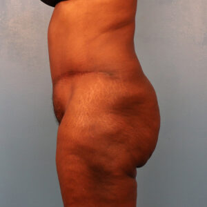 Case--43472 | After Tummy Tuck (Abdominoplasty) 2