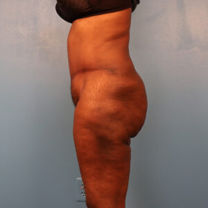 Case--7319 | After Abdominoplasty 2