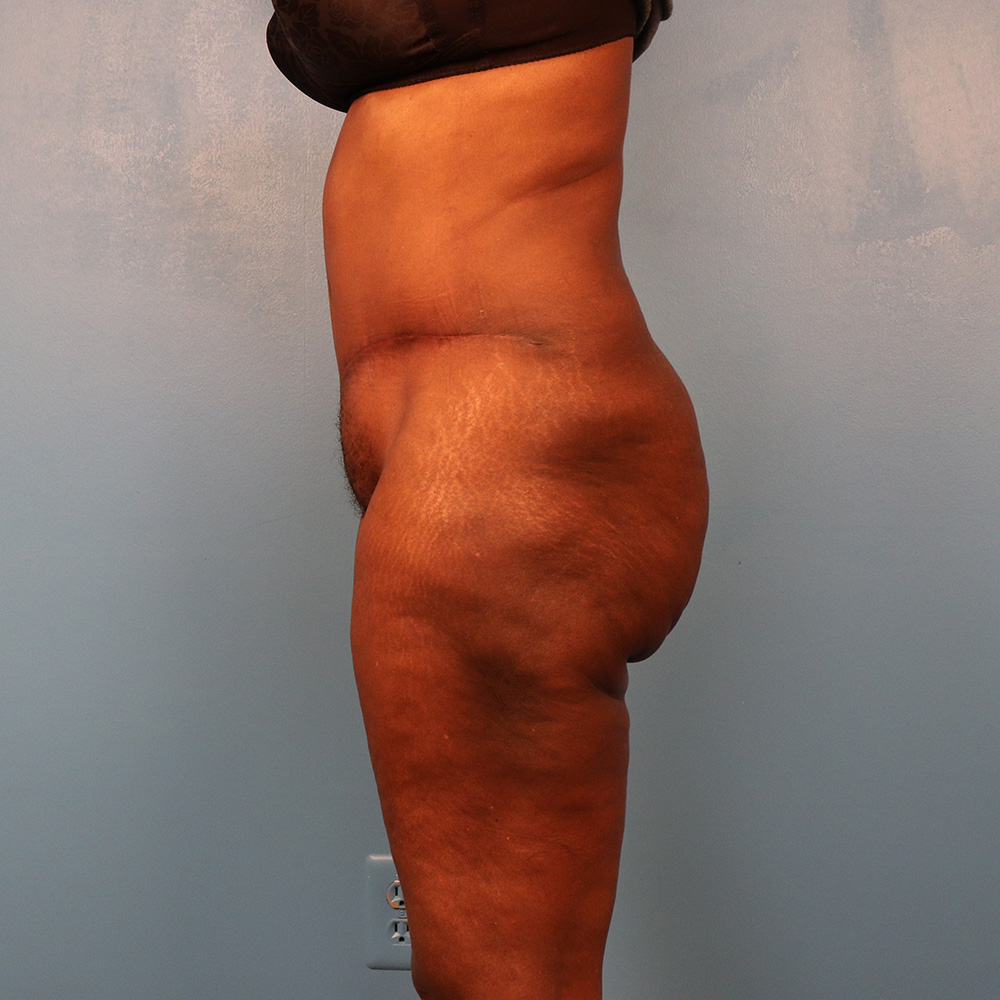 Case--7319 | After Abdominoplasty 2