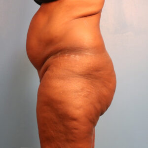 Case--43472 | Before Tummy Tuck (Abdominoplasty) 2