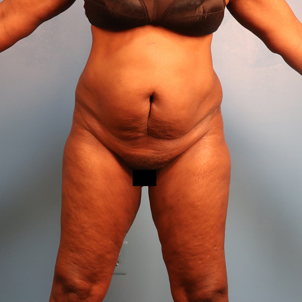 Case--7319 | Before Abdominoplasty