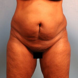 Case--43472 | Before Tummy Tuck (Abdominoplasty) 1