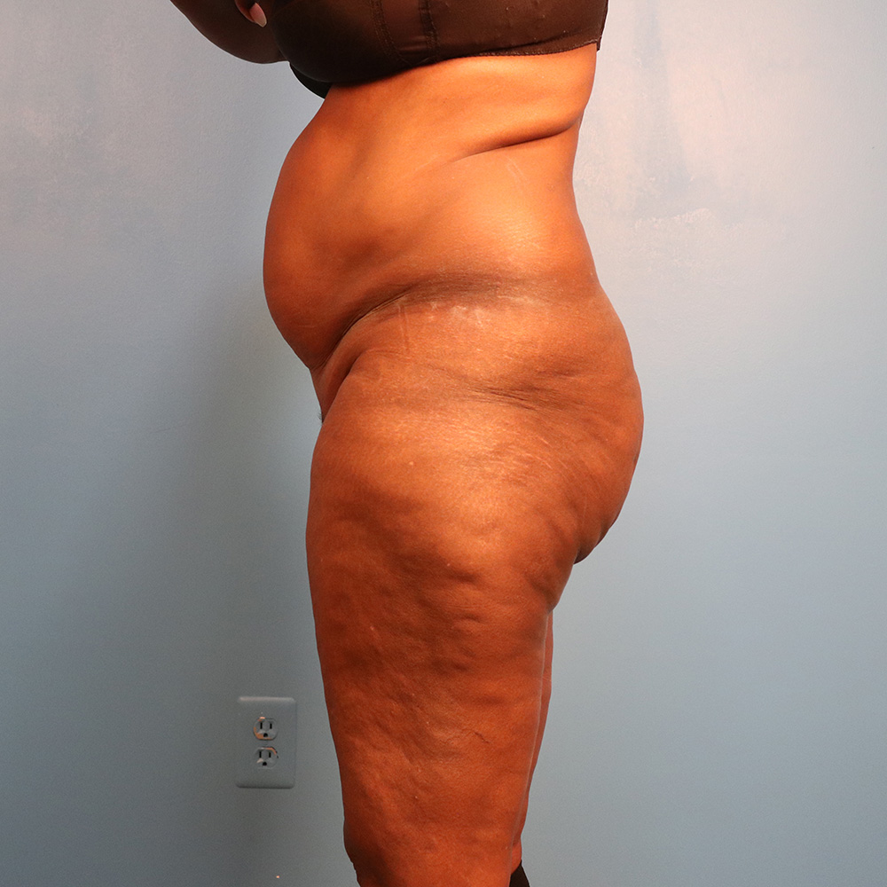 Case--7319 | Before Abdominoplasty 2