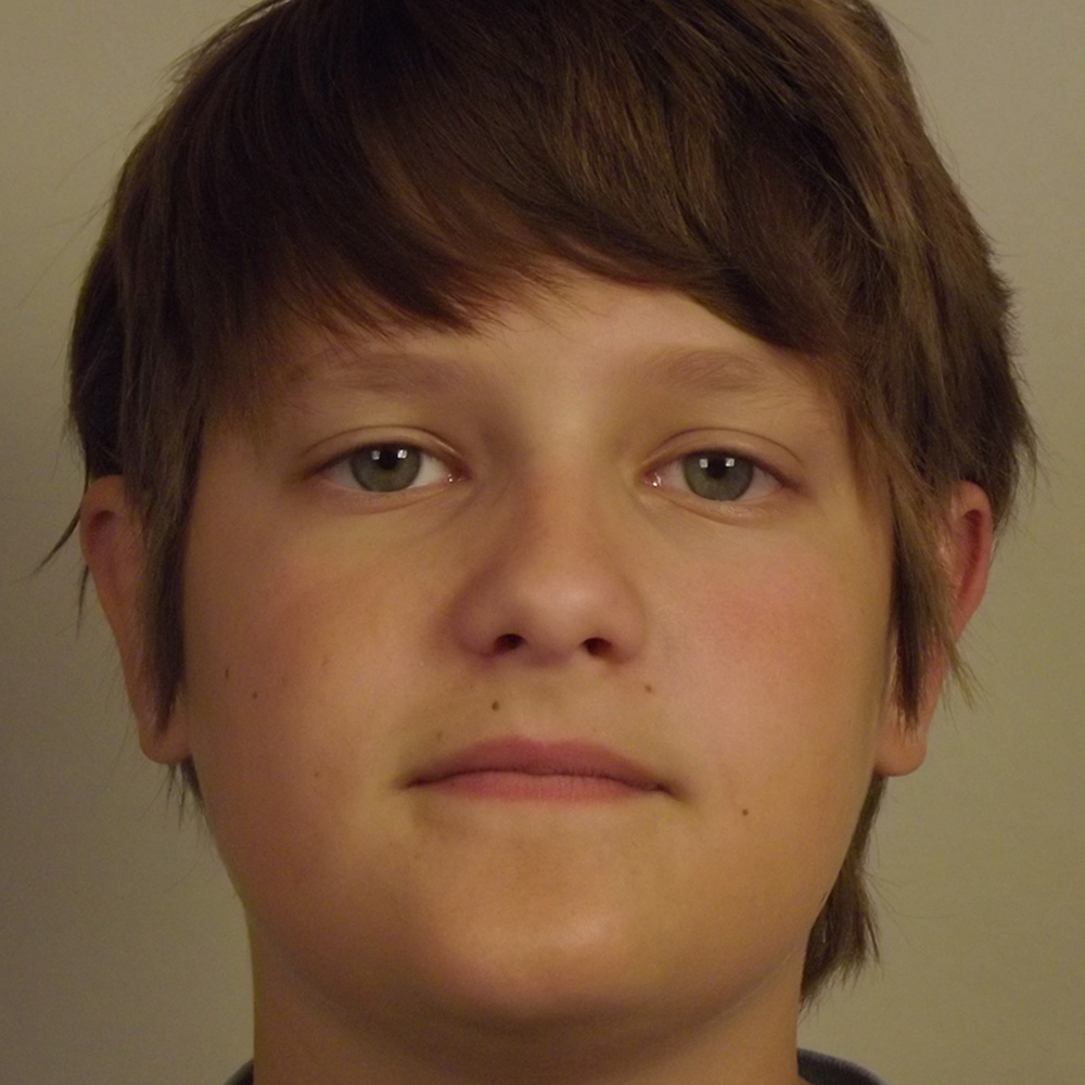 Case--2246 | After Face