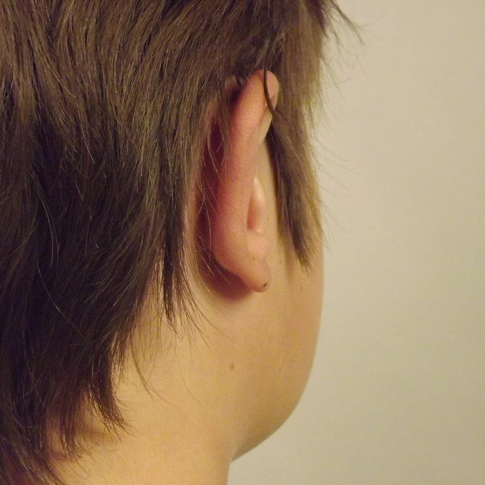 Case--2246 | After Otoplasty 2