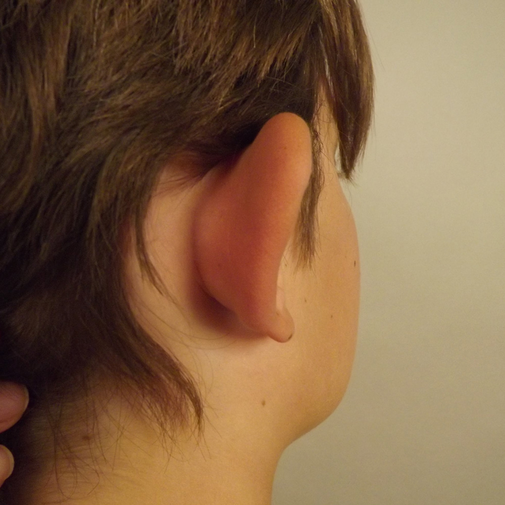 Case--2246 | Before Otoplasty 2