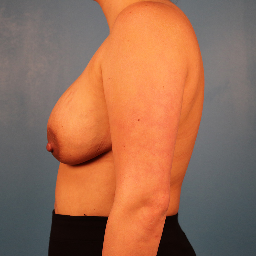 Case--8480 | Before Implant Exchange-Mastopexy 2