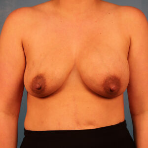 Case--8480 | Before Implant Exchange-Mastopexy 1