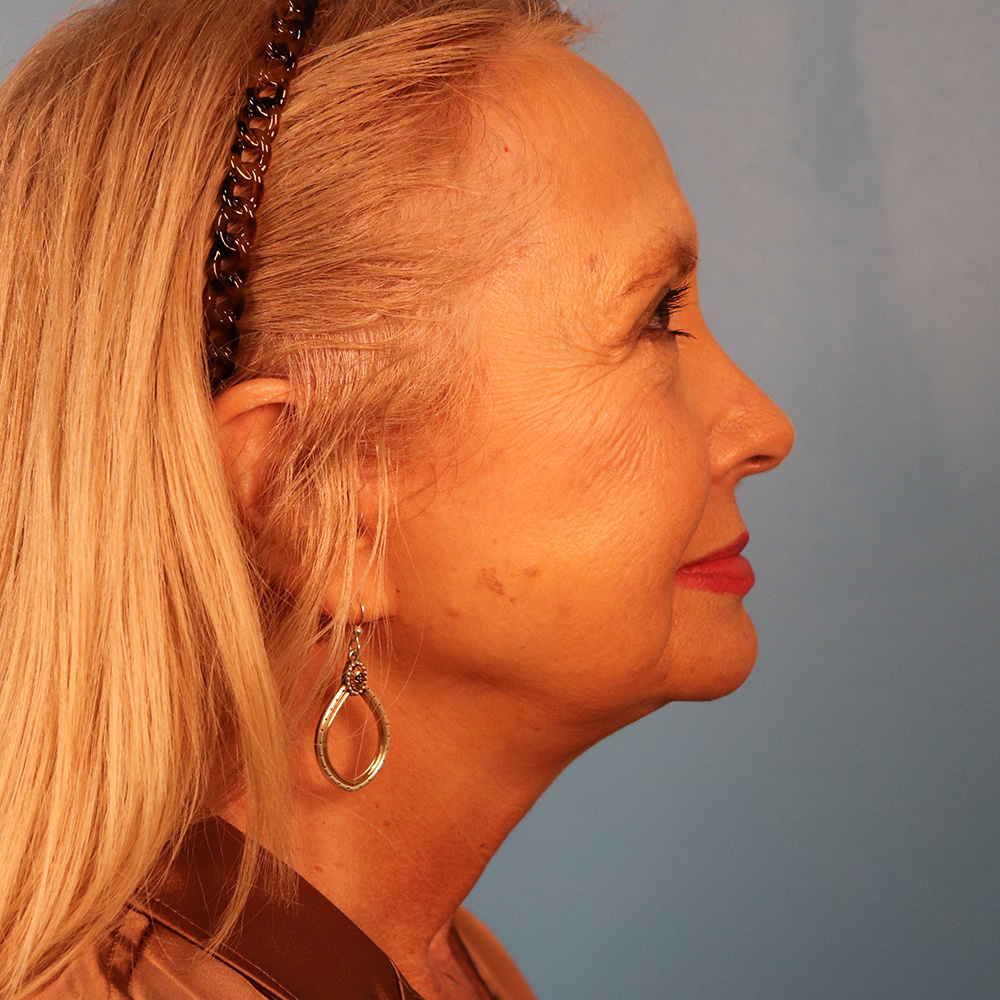 Case--2298 | After Facelift 2