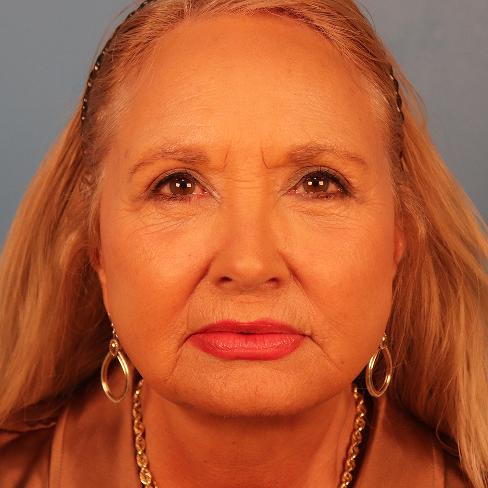 Case--2298 | After Facelift